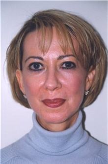 Facelift After Photo by Scott Tucker, MD; Winston-Salem, NC - Case 40347