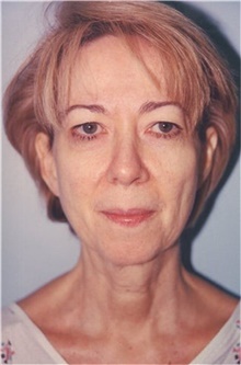 Facelift Before Photo by Scott Tucker, MD; Winston-Salem, NC - Case 40347