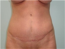 Tummy Tuck After Photo by Scott Tucker, MD; Winston-Salem, NC - Case 40370