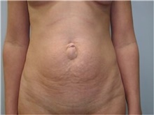 Tummy Tuck Before Photo by Scott Tucker, MD; Winston-Salem, NC - Case 40370
