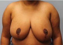 Breast Reduction After Photo by Scott Tucker, MD; Winston-Salem, NC - Case 40530