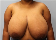 Breast Reduction Before Photo by Scott Tucker, MD; Winston-Salem, NC - Case 40530