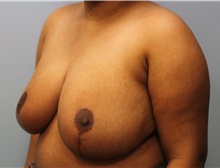 Breast Reduction After Photo by Scott Tucker, MD; Winston-Salem, NC - Case 40530
