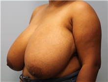 Breast Reduction Before Photo by Scott Tucker, MD; Winston-Salem, NC - Case 40530