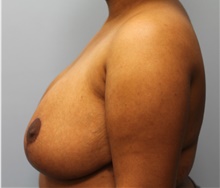 Breast Reduction After Photo by Scott Tucker, MD; Winston-Salem, NC - Case 40530
