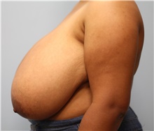 Breast Reduction Before Photo by Scott Tucker, MD; Winston-Salem, NC - Case 40530