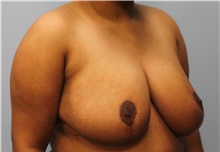 Breast Reduction After Photo by Scott Tucker, MD; Winston-Salem, NC - Case 40530
