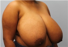 Breast Reduction Before Photo by Scott Tucker, MD; Winston-Salem, NC - Case 40530