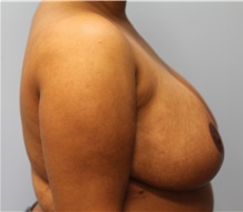 Breast Reduction After Photo by Scott Tucker, MD; Winston-Salem, NC - Case 40530