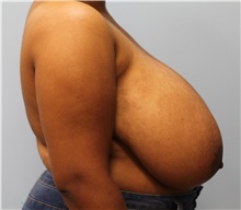 Breast Reduction Before Photo by Scott Tucker, MD; Winston-Salem, NC - Case 40530
