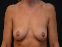 Breast Augmentation Before Photo by Isaac Starker, MD; Florham Park, NJ - Case 29524