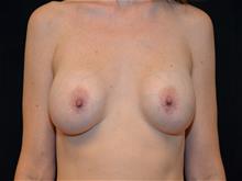 Breast Augmentation Before Photo by Isaac Starker, MD; Florham Park, NJ - Case 29528