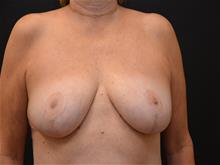 Breast Reduction After Photo by Isaac Starker, MD; Florham Park, NJ - Case 29529