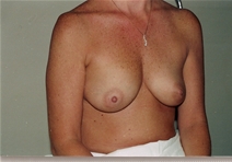 Breast Augmentation Before Photo by Joe Griffin, MD; Florence, SC - Case 22800