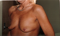 Breast Augmentation Before Photo by Joe Griffin, MD; Florence, SC - Case 22801