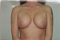 Breast Augmentation After Photo by Joe Griffin, MD; Florence, SC - Case 22803
