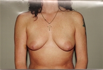 Breast Augmentation Before Photo by Joe Griffin, MD; Florence, SC - Case 22803