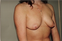 Breast Augmentation Before Photo by Joe Griffin, MD; Florence, SC - Case 22803