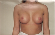Breast Augmentation After Photo by Joe Griffin, MD; Florence, SC - Case 22808