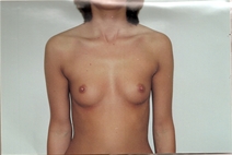 Breast Augmentation Before Photo by Joe Griffin, MD; Florence, SC - Case 22808
