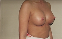 Breast Augmentation After Photo by Joe Griffin, MD; Florence, SC - Case 22808