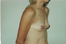 Breast Augmentation Before Photo by Joe Griffin, MD; Florence, SC - Case 22809