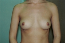 Breast Augmentation Before Photo by Joe Griffin, MD; Florence, SC - Case 22810