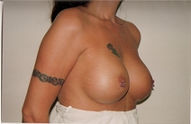 Breast Augmentation After Photo by Joe Griffin, MD; Florence, SC - Case 22811