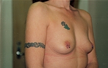 Breast Augmentation Before Photo by Joe Griffin, MD; Florence, SC - Case 22811