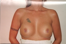 Breast Augmentation After Photo by Joe Griffin, MD; Florence, SC - Case 22811