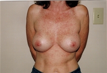 Breast Augmentation After Photo by Joe Griffin, MD; Florence, SC - Case 22812