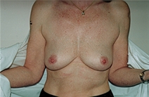 Breast Augmentation Before Photo by Joe Griffin, MD; Florence, SC - Case 22812