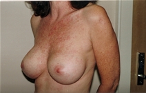 Breast Augmentation After Photo by Joe Griffin, MD; Florence, SC - Case 22812