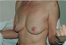 Breast Augmentation Before Photo by Joe Griffin, MD; Florence, SC - Case 22812