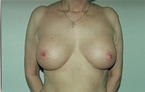 Breast Augmentation After Photo by Joe Griffin, MD; Florence, SC - Case 22813