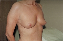 Breast Augmentation Before Photo by Joe Griffin, MD; Florence, SC - Case 22813