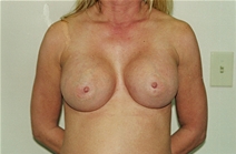 Breast Augmentation After Photo by Joe Griffin, MD; Florence, SC - Case 22816