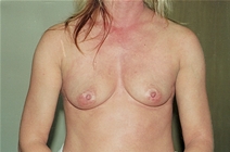 Breast Augmentation Before Photo by Joe Griffin, MD; Florence, SC - Case 22816