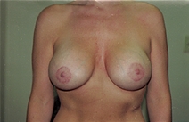 Breast Augmentation After Photo by Joe Griffin, MD; Florence, SC - Case 22817