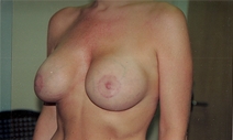 Breast Augmentation After Photo by Joe Griffin, MD; Florence, SC - Case 22817