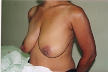 Breast Augmentation Before Photo by Joe Griffin, MD; Florence, SC - Case 22818