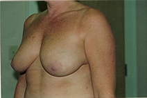 Breast Lift Before Photo by Joe Griffin, MD; Florence, SC - Case 22820