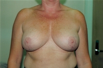 Breast Lift After Photo by Joe Griffin, MD; Florence, SC - Case 22820