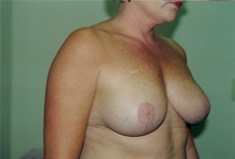 Breast Lift After Photo by Joe Griffin, MD; Florence, SC - Case 22820