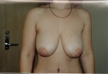 Breast Lift Before Photo by Joe Griffin, MD; Florence, SC - Case 22822
