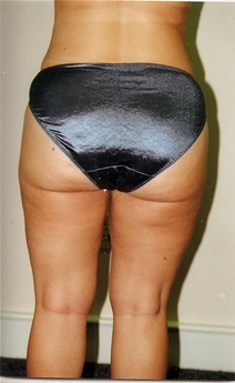 Liposuction After Photo by Joe Griffin, MD; Florence, SC - Case 22823