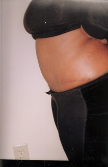 Tummy Tuck After Photo by Joe Griffin, MD; Florence, SC - Case 22824