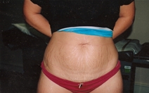 Tummy Tuck Before Photo by Joe Griffin, MD; Florence, SC - Case 22825