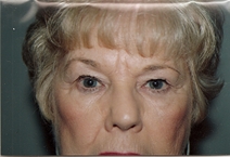 Eyelid Surgery Before Photo by Joe Griffin, MD; Florence, SC - Case 22826
