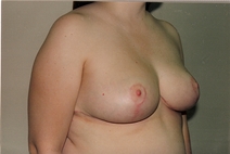 Breast Reduction After Photo by Joe Griffin, MD; Florence, SC - Case 22830